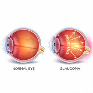 Understanding Glaucoma